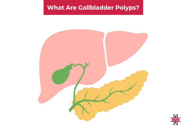 Gallbladder Polyps Symptoms Causes Types And Treatment Er Of Mesquite