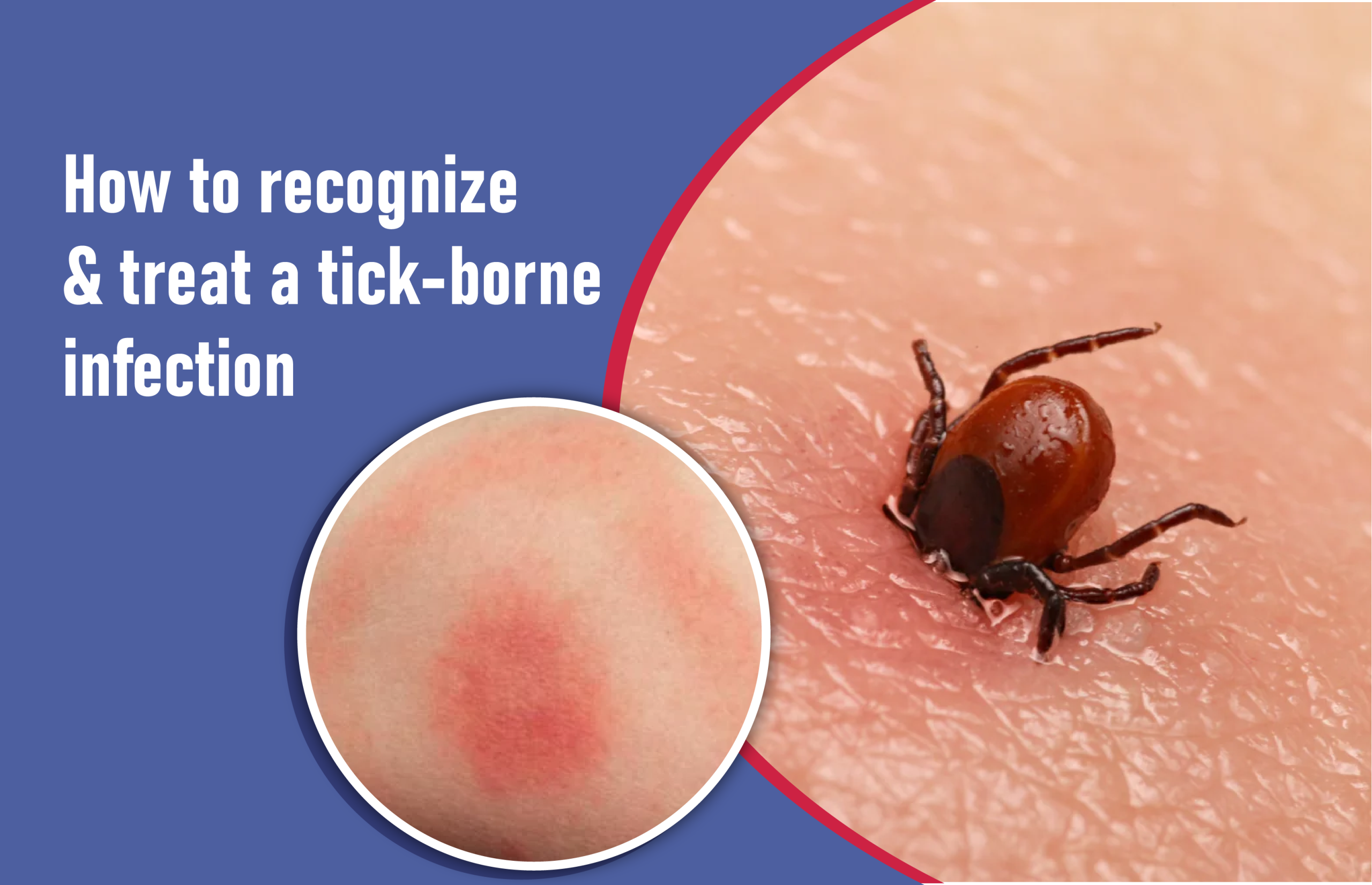How to Recognize and Treat a Tick-borne Infection