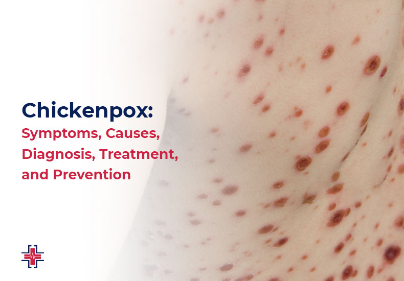 Chickenpox - Symptoms, Causes, Diagnosis, Treatment and Prevention - ER of Mesquite