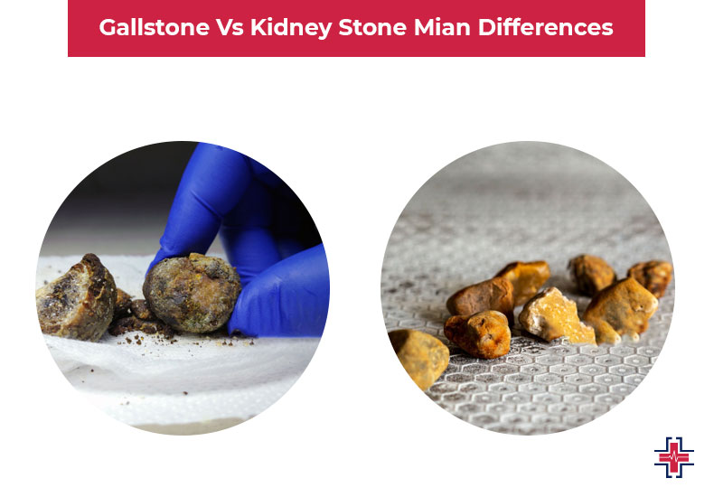Gallstone vs Kidney Stone - Mian Differences - ER of Mesquite