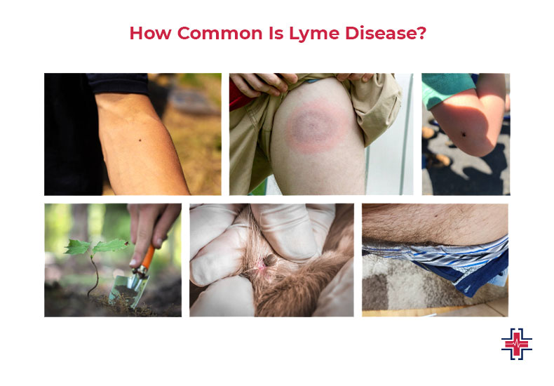 How Common Is Lyme Disease - ER of Mesquite