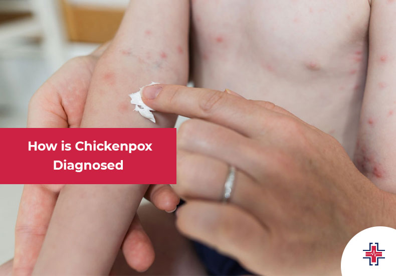 How is Chickenpox Diagnosed - ER of Mesquite
