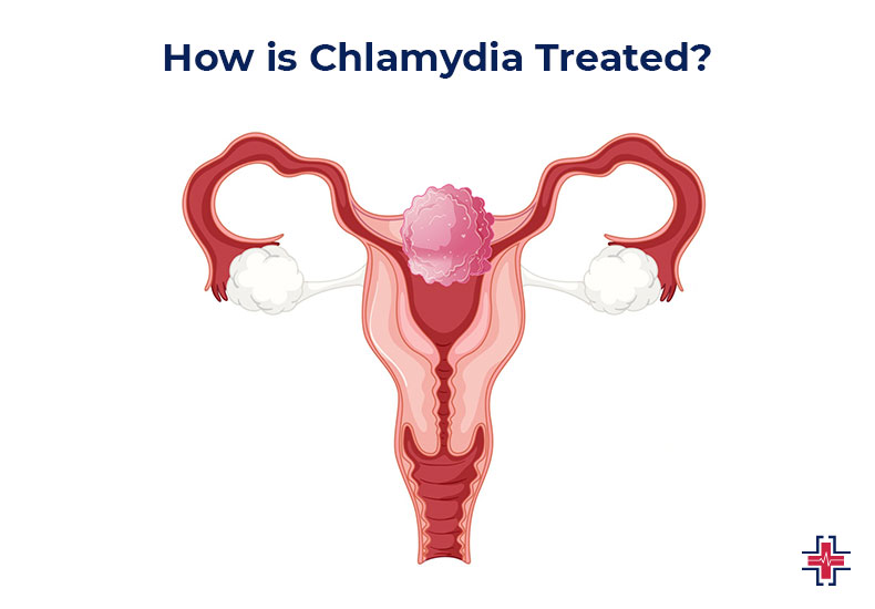 How is Chlamydia Treated - ER of Mesquite
