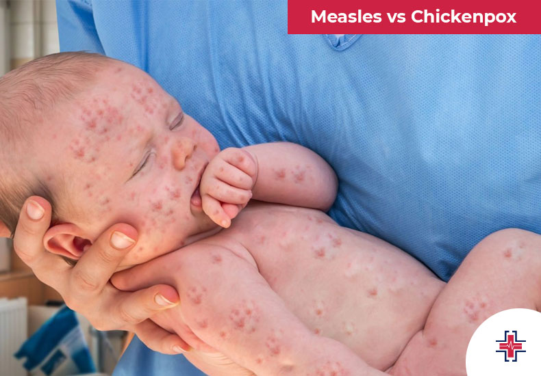 Measles vs Chickenpox - ER of Mesquite