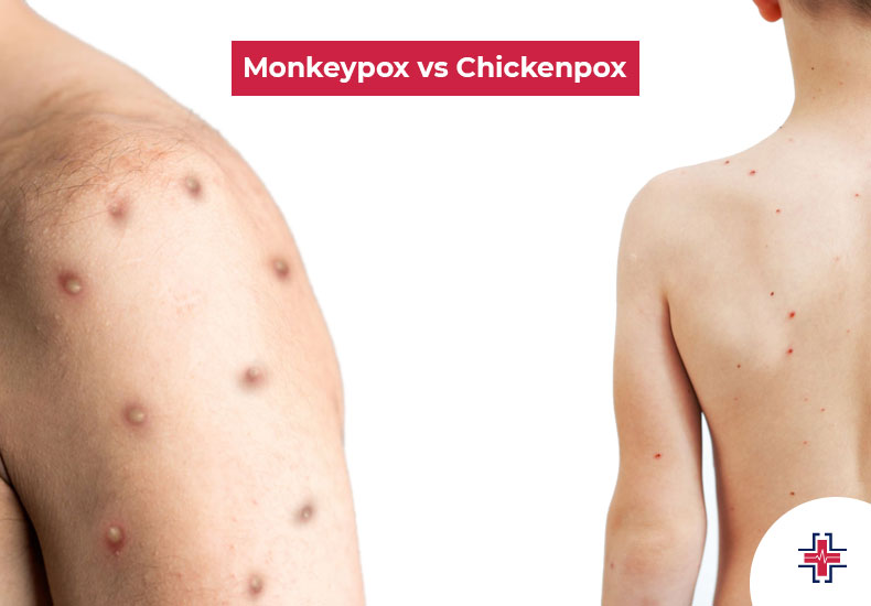 Monkeypox vs Chickenpox - ER of Mesquite