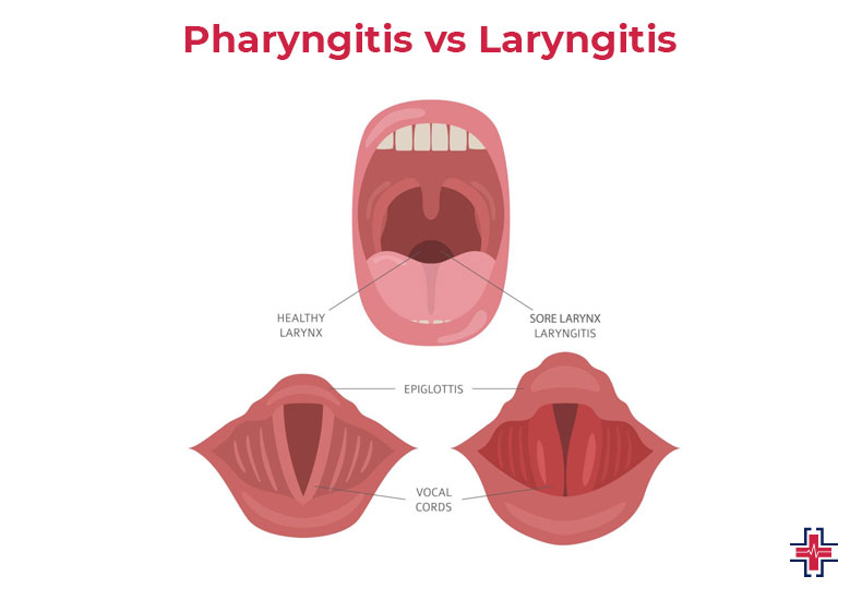 Pharyngitis vs Laryngitis - ER of Mesquite