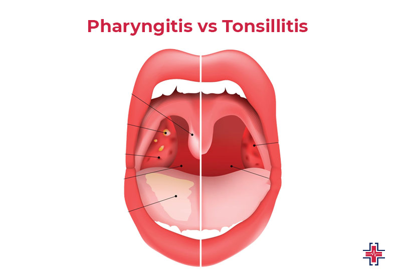 Pharyngitis vs Tonsillitis - ER of Mesquite