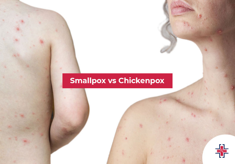 Smallpox vs Chickenpox - ER of Mesquite