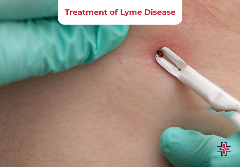 Treatment of Lyme Disease - ER of Mesquite