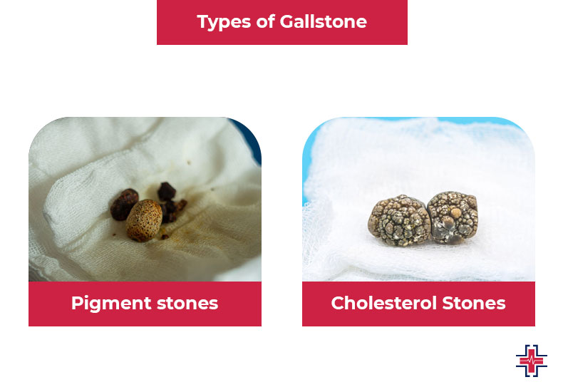 Types of Gallstone - ER of Mesquite