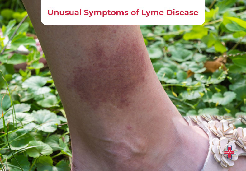 Unusual Symptoms of Lyme Disease - ER of Mesquite