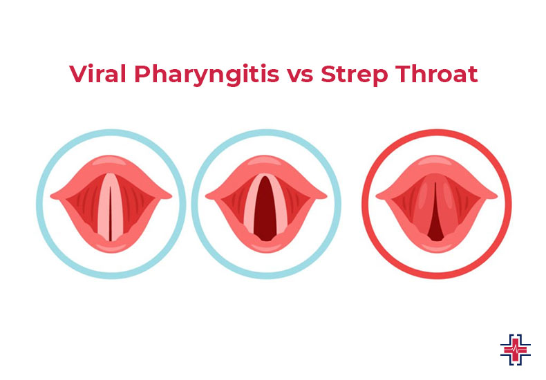 Viral Pharyngitis vs Strep Throat - ER of Mesquite