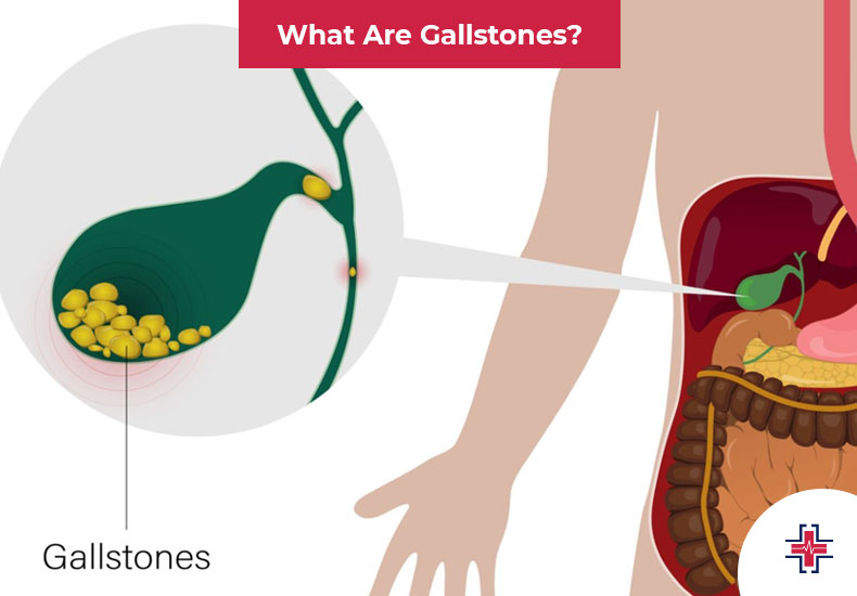 What are Gallstones - ER of Mesquite