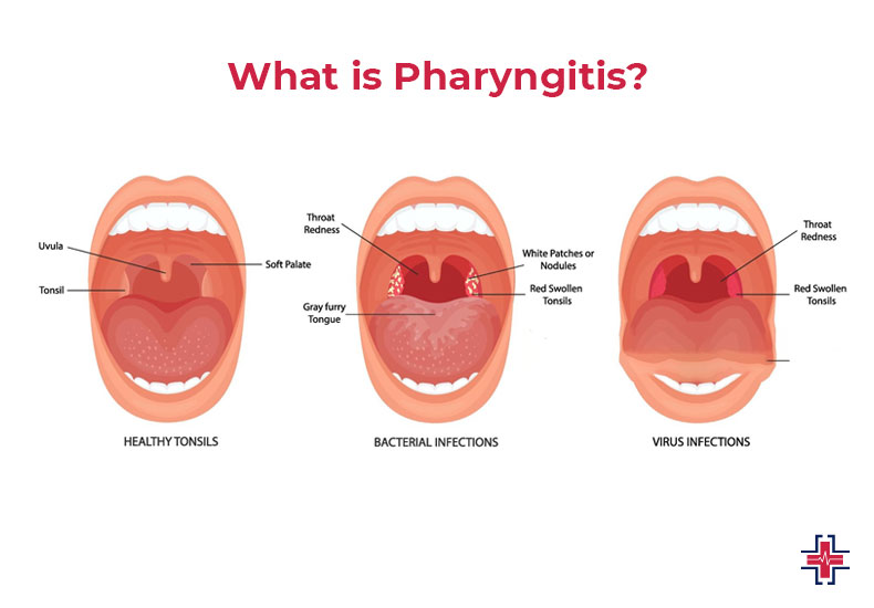 What is Pharyngitis - ER of Mesquite