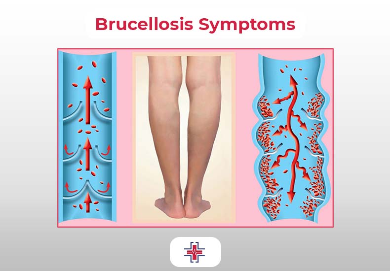 Brucellosis Symptoms - ER of Mesquite