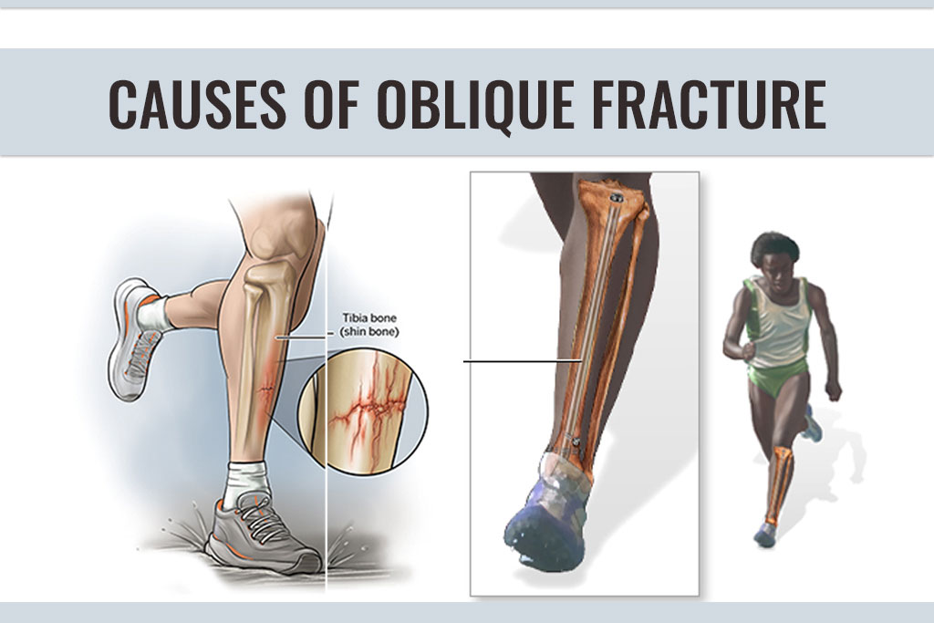 Causes of Oblique Fracture - ER of Mesquite