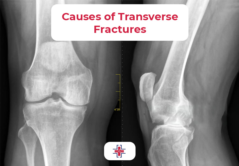 Causes of Transverse Fractures - ER of Mesquite