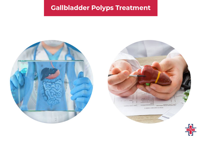 Gallbladder Polyps Treatment - ER of Mesquite