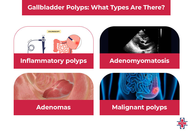 Gallbladder Polyps - What Types Are There - ER of Mesquite