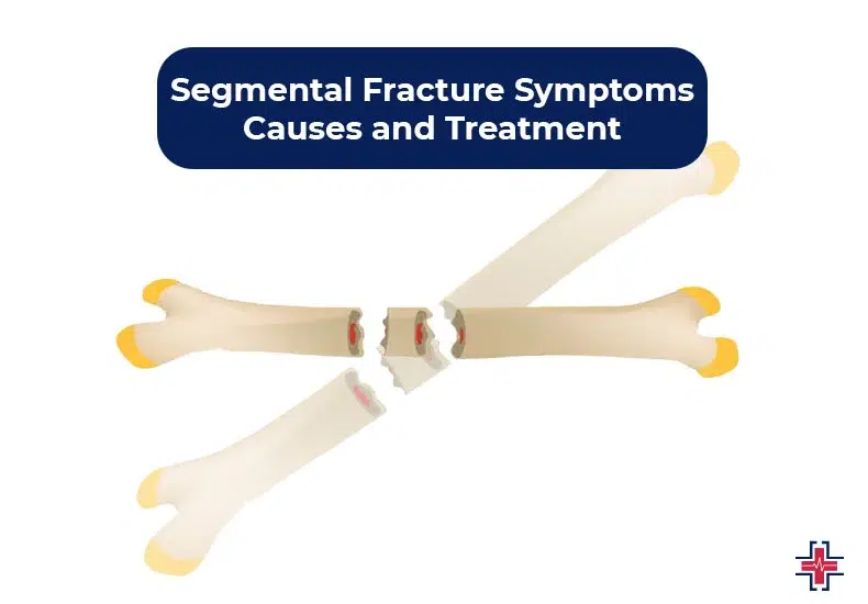 Segmental Fracture - Symptoms, Causes and Treatment - ER of Mesquite