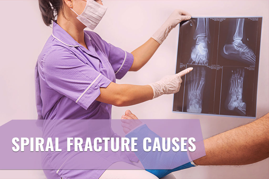 Spiral Fracture Causes - ER of Mesquite