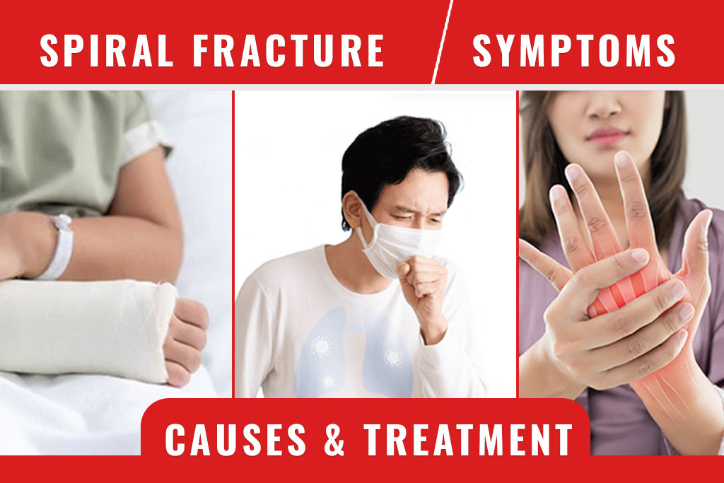 Spiral Fracture Symptoms, Causes & Treatment - ER of Mesquite