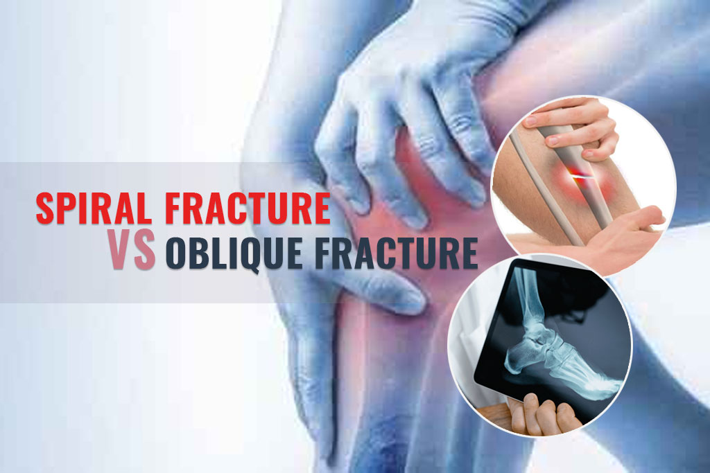 Spiral Fracture vs Oblique Fracture - ER of Mesquite