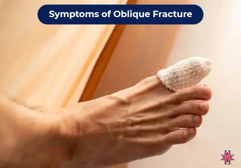 Symptoms of Oblique Fracture - ER of Mesquite