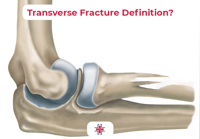 Transverse Fracture Definition - ER of Mesquite