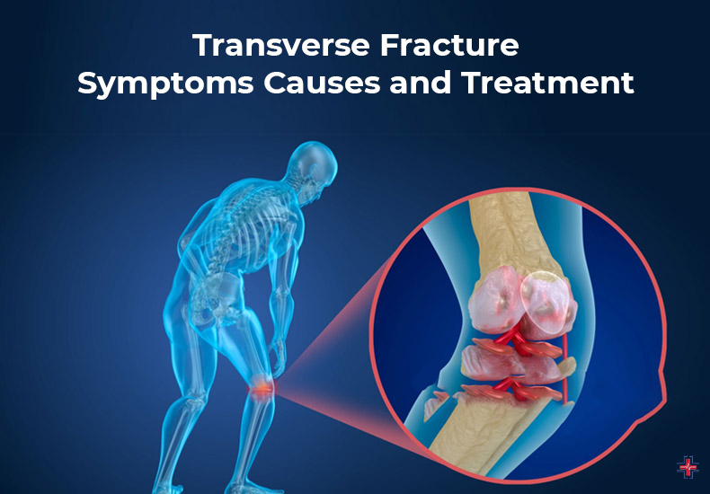 Transverse Fracture - Symptoms, Causes and Treatment - ER of Mesquite