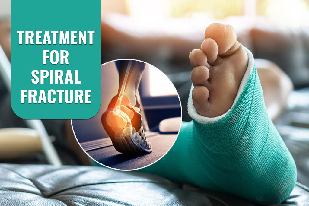 Treatment for Spiral Fracture - ER of Mesquite