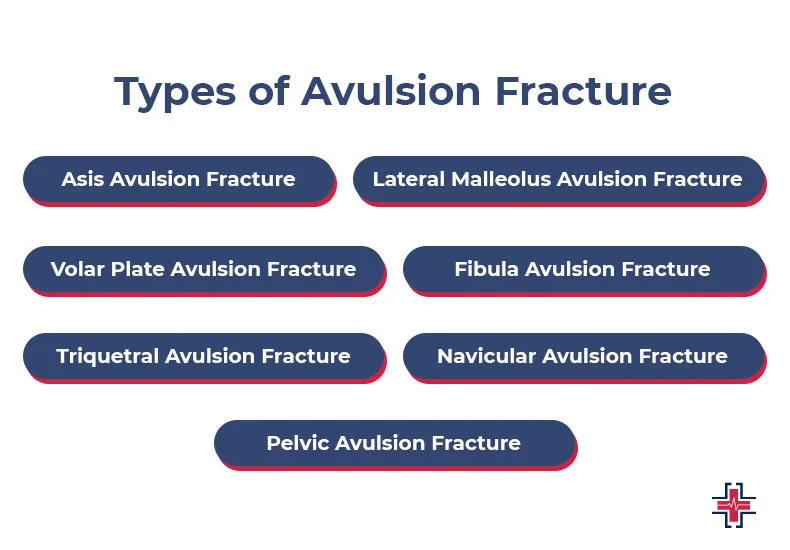 Types of Avulsion Fracture - ER of Mesquite