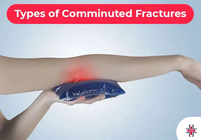 Types of Comminuted Fractures - ER of Mesquite