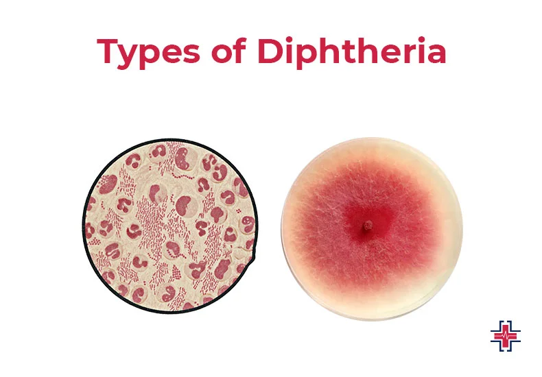Types of Diphtheria - ER of Mesquite
