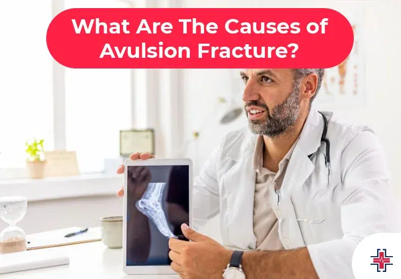 What Are The Causes of Avulsion Fracture - ER of Mesquite