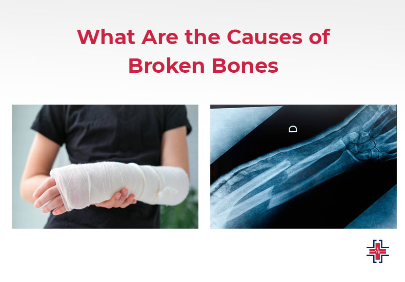 What Are The Causes of Broken Bones - ER of Mesquite