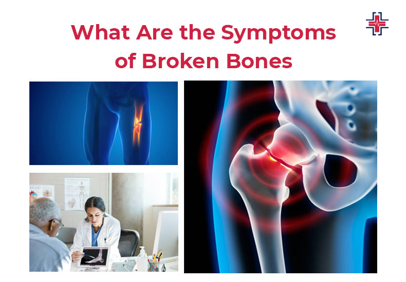 What Are The Symptoms of Broken Bones - ER of Mesquite