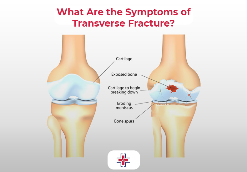 What Are the Symptoms of Transverse Fracture - ER of Mesquite
