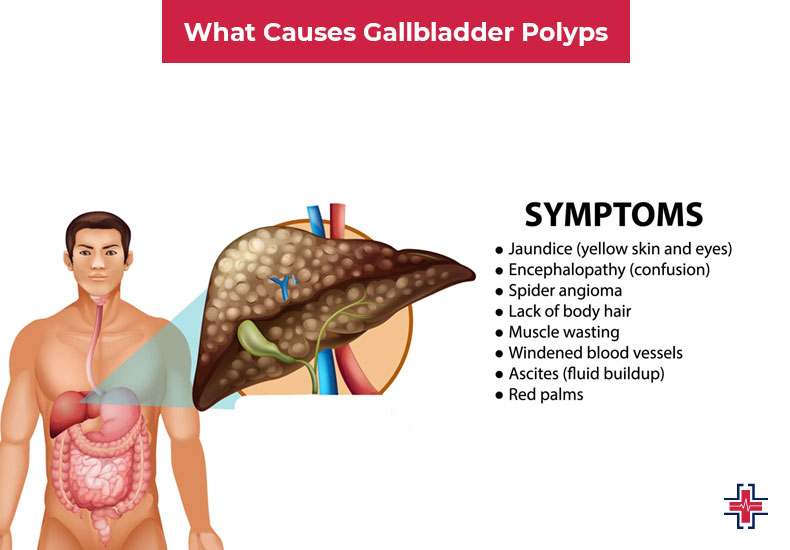 What Causes Gallbladder Polyps - ER of Mesquite