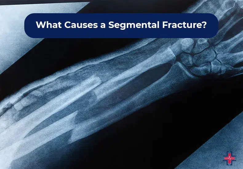 What Causes a Segmental Fracture - ER of Mesquite