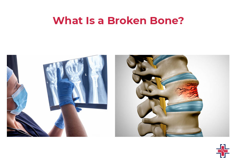 What Is A Broken Bone - ER of Mesquite