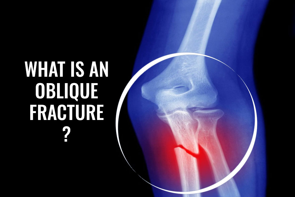 What Is An Oblique Fracture - ER of Mesquite