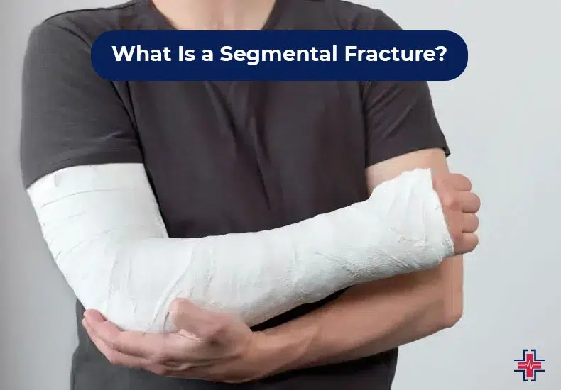What Is a Segmental Fracture - ER of Mesquite