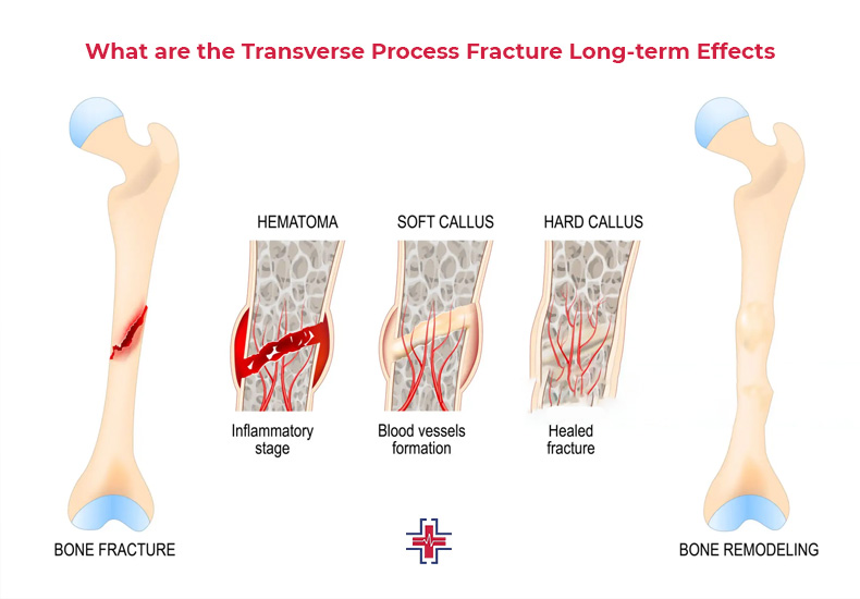 What are the Transverse Process Fracture - Long Term Effects - ER of Mesquite