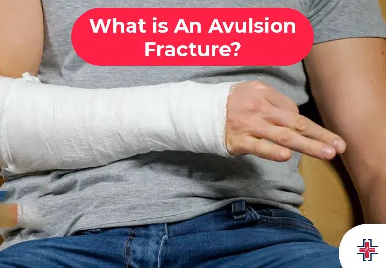What is An Avulsion Fracture - ER of Mesquite
