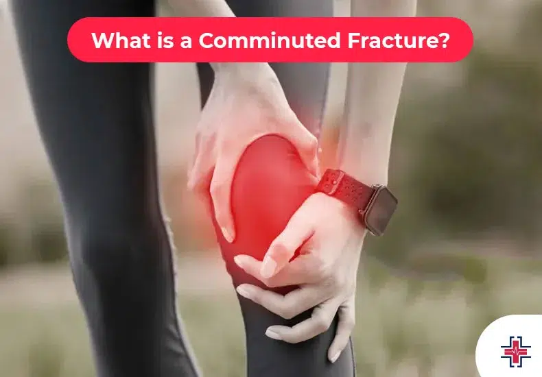 What is a Comminuted Fracture - ER of Mesquite