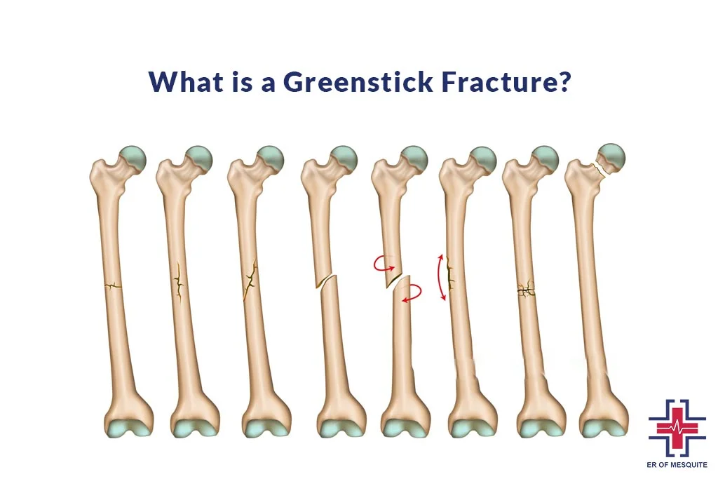 What is a Greenstick Fracture - ER of Mesquite