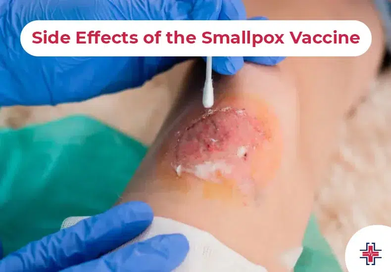 Side Effects of the Smallpox Vaccine - ER of Mesquite