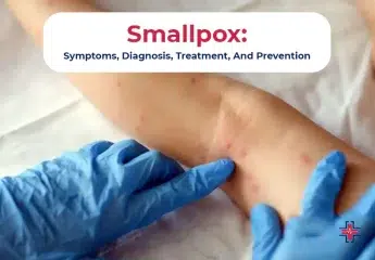Smallpox - Symptoms Diagnosis Treatment And Prevention - ER of Mesquite