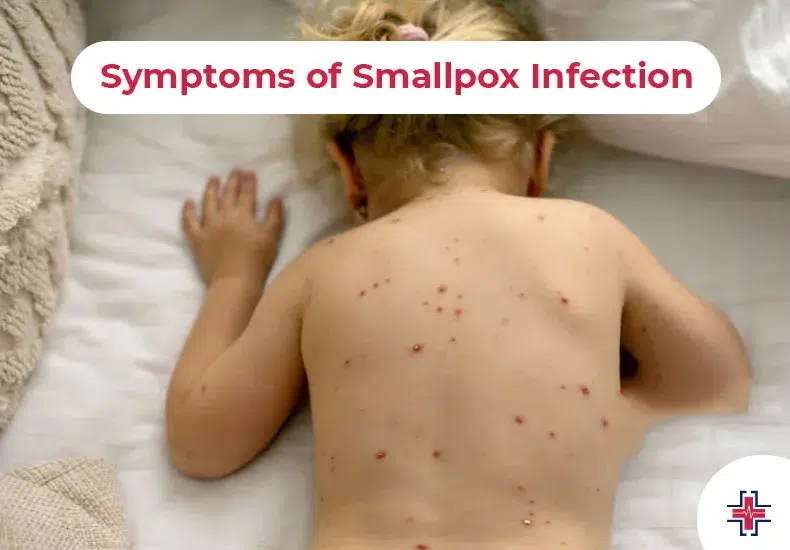 Symptoms of Smallpox Infection - ER of Mesquite